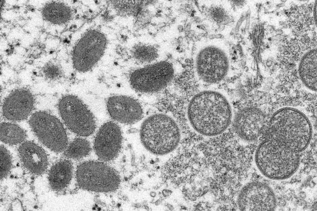 This 2003 electron microscope image made available by the Centers for Disease Control and Prevention shows mature, oval-shaped monkeypox virions, left, and spherical immature virions, right, obtained from a sample of human skin associated with the 2003